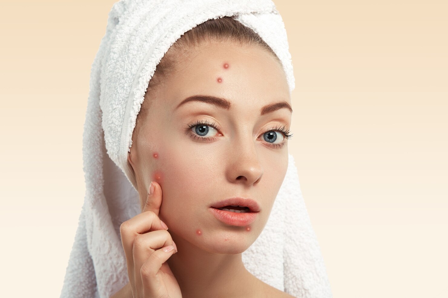 10 Smart Tips to Manage Acne This Summer (Expert Advice from RS Skin and Hair Transplant, Rohini)