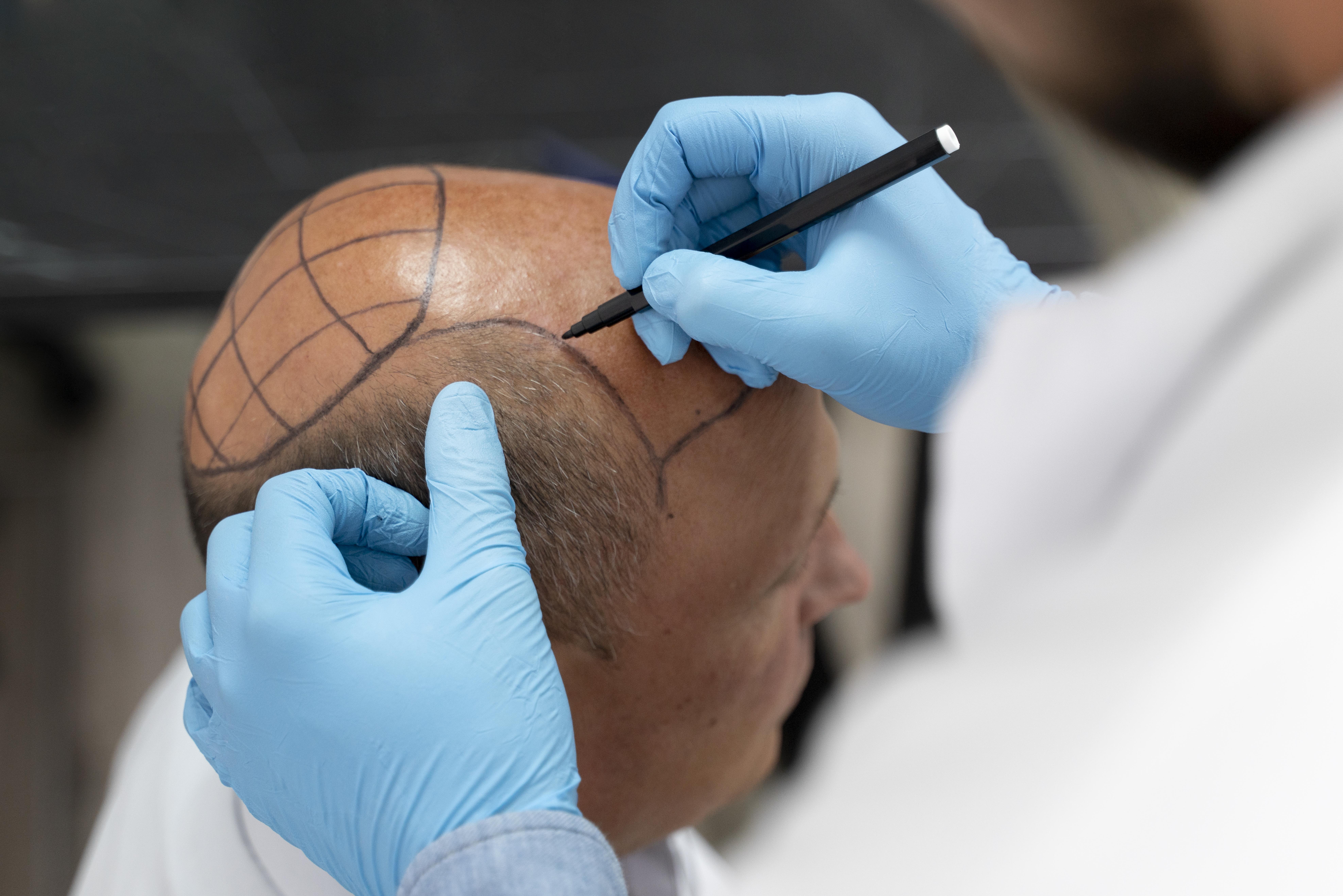 How Hair Transplant Graft Placement Creates Natural Results